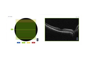 EyeVinci introduceert AI-technologie 