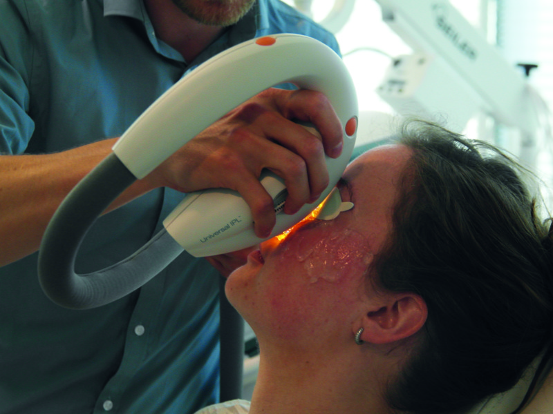 Workshop: Behandel Droge Ogen met IPL 
