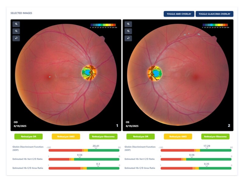 EyeVinci introduceert AI-technologie 